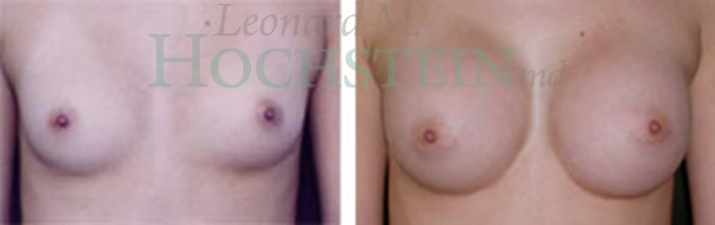 Breast Augmentation Patient
