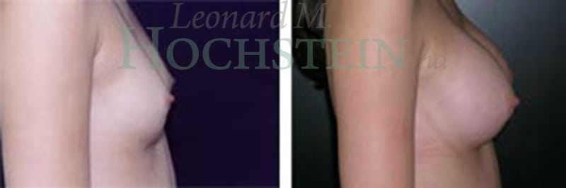 Breast Augmentation Patient