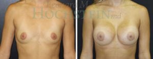 Breast Augmentation Patient