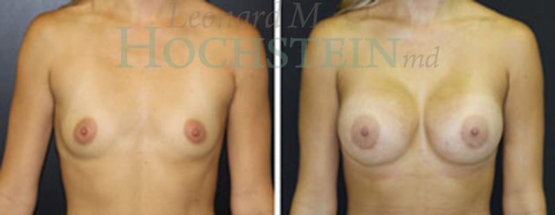 Breast Augmentation Patient