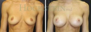 Breast Augmentation Patient