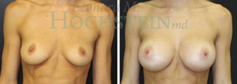 Breast Augmentation Patient