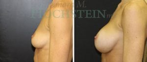 Breast Augmentation Patient