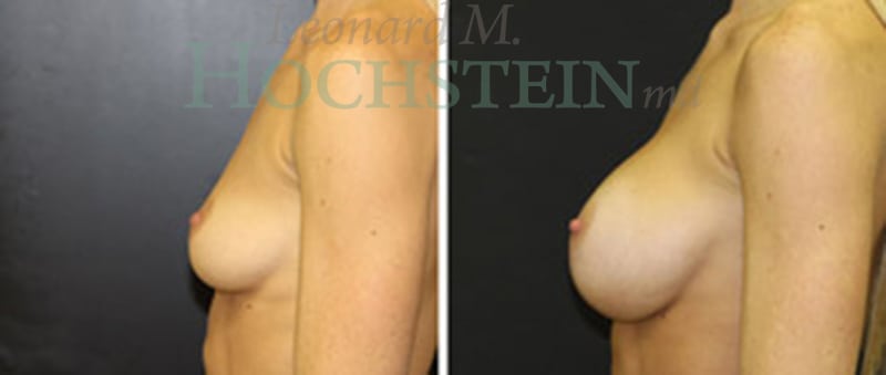 Breast Augmentation Patient