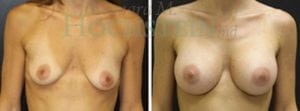 Breast Augmentation Patient