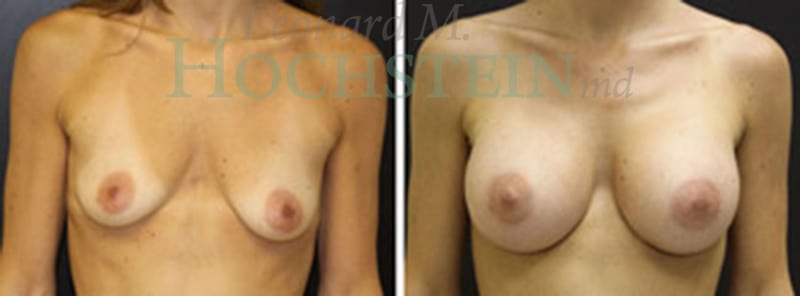 Breast Augmentation Patient