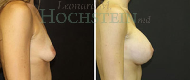 Breast Augmentation Patient