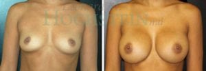 Breast Augmentation Patient