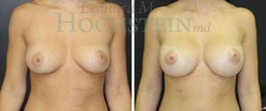 Breast Augmentation Patient