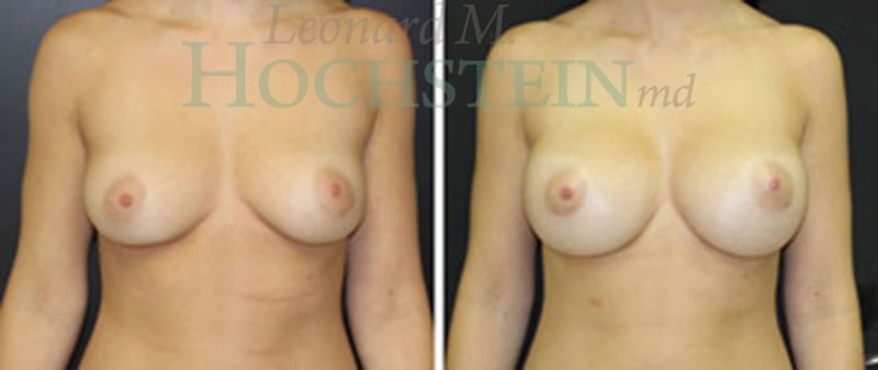 Breast Augmentation Patient