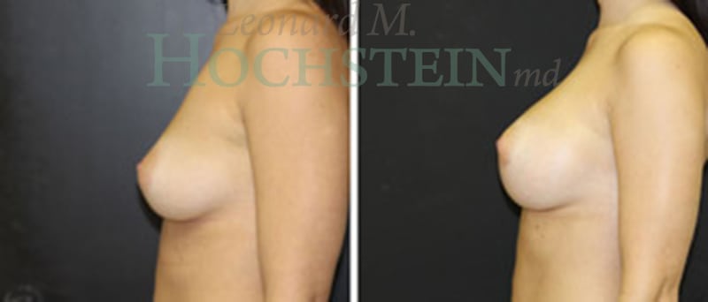 Breast Augmentation Patient
