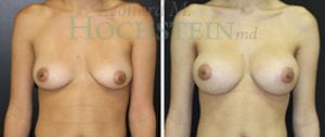 Breast Augmentation Patient