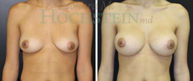 Breast Augmentation Patient