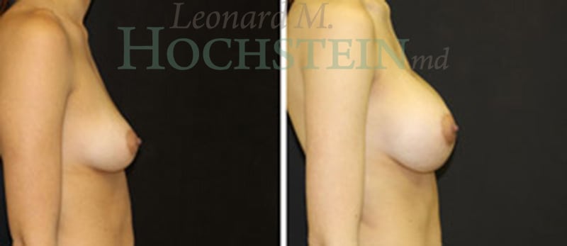 Breast Augmentation Patient