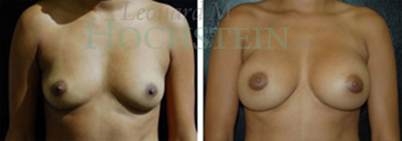 Breast Augmentation Patient