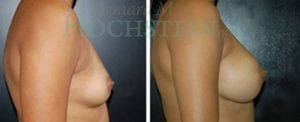 Breast Augmentation Patient