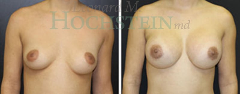 Breast Augmentation Patient