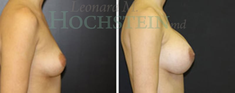 Breast Augmentation Patient