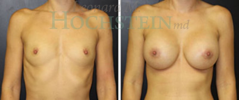 Breast Augmentation Patient
