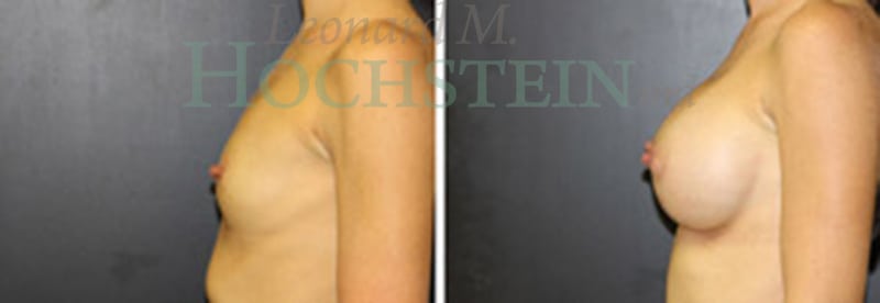 Breast Augmentation Patient