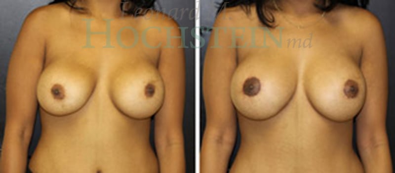 Breast Augmentation Patient