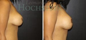 Breast Augmentation Patient