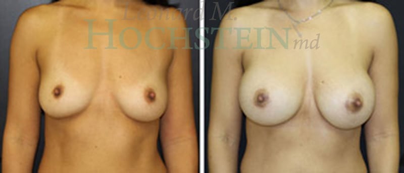 Breast Augmentation Patient