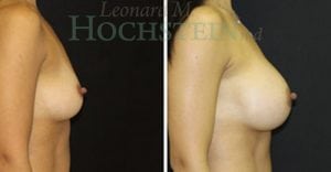 Breast Augmentation Patient