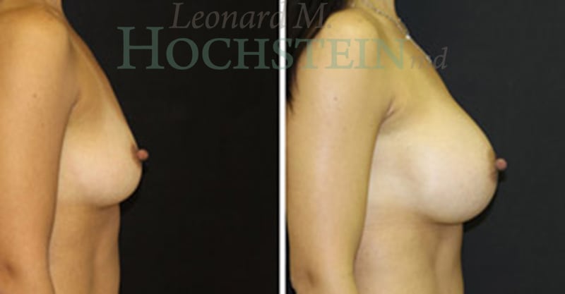 Breast Augmentation Patient