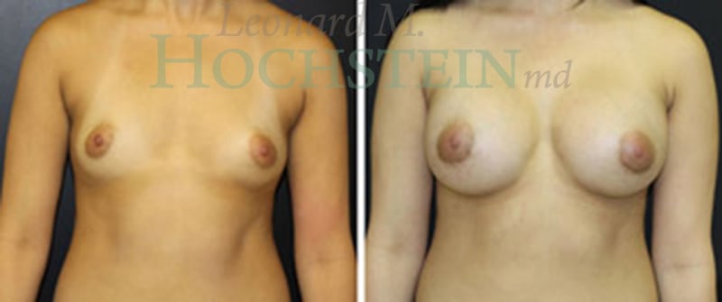 Breast Augmentation Patient