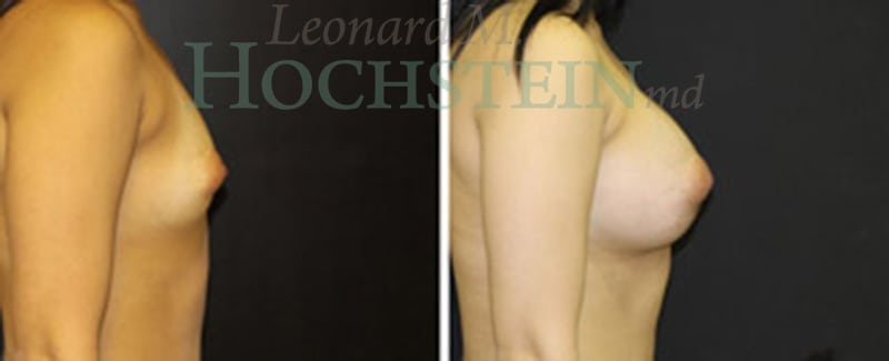 Breast Augmentation Patient
