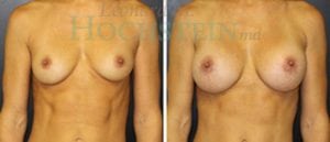 Breast Augmentation Patient