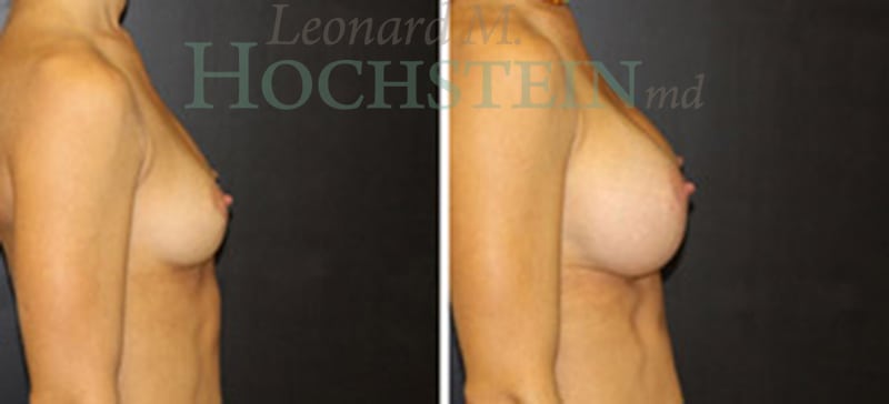 Breast Augmentation Patient