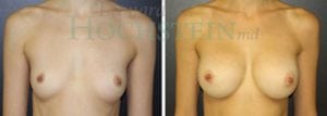 Breast Augmentation Patient