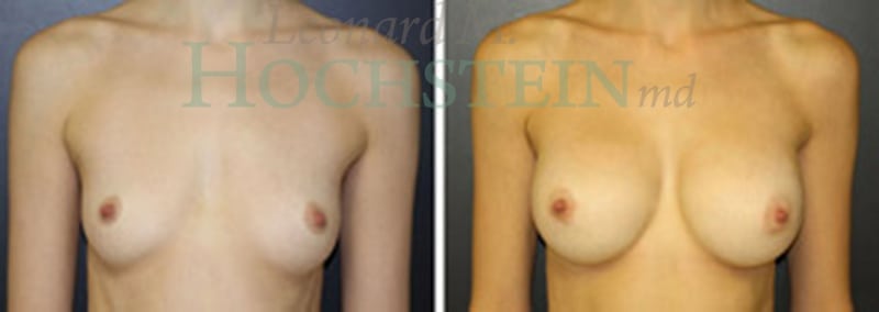 Breast Augmentation Patient
