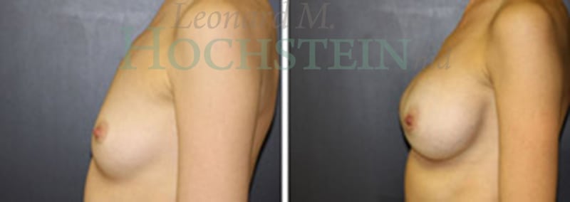 Breast Augmentation Patient