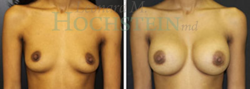 Breast Augmentation Patient