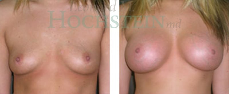 Breast Augmentation Patient