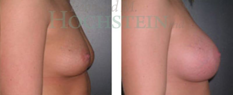 Breast Augmentation Patient