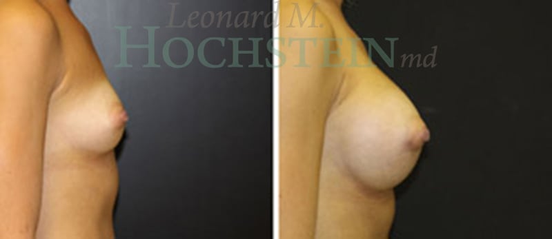 Breast Augmentation Patient