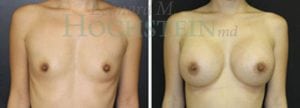 Breast Augmentation Patient