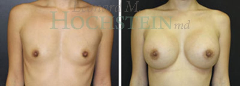 Breast Augmentation Patient