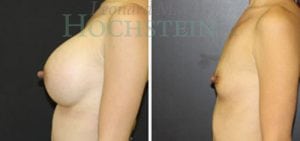 Breast Augmentation Patient