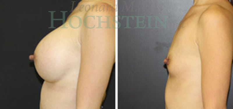Breast Augmentation Patient