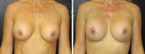 Breast Augmentation Patient