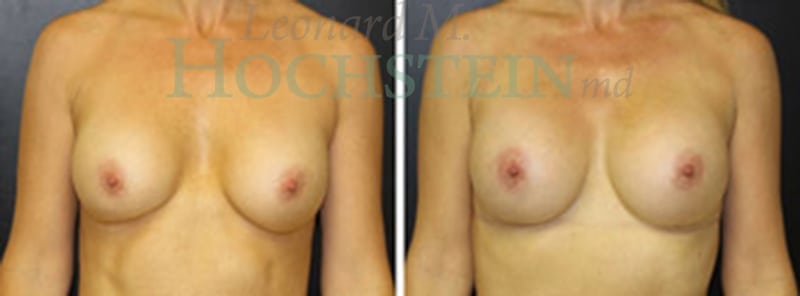 Breast Augmentation Patient