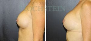 Breast Augmentation Patient