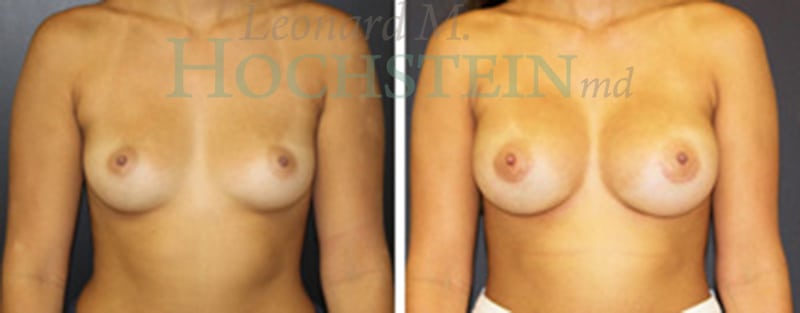 Breast Augmentation Patient