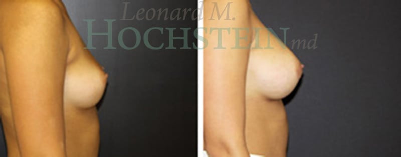 Breast Augmentation Patient