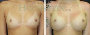 Breast Augmentation Patient